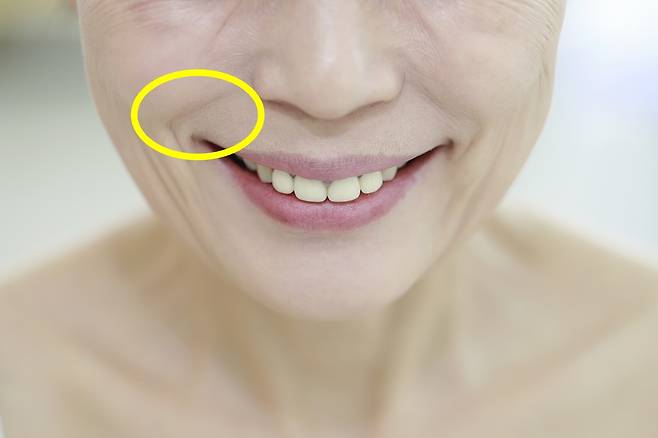 많이 웃으면 팔자 주름이 생긴다고 생각하는 사람이 많다./사진=게티이미지뱅크