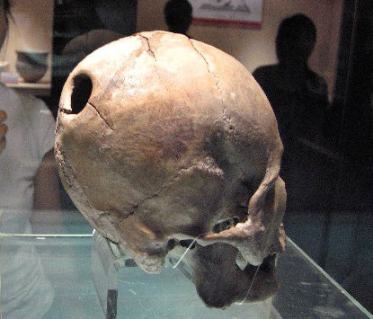 중국 산둥반도 유적에서 출토된 5000년 전 머리뼈에 직경 3cm가 넘는 구멍이 뚫려 있다(왼쪽 사진). 수술 흔적으로 추정되는데, 뼈가 한동안 자란 것으로 보아 환자가 상당 기간 생존했음을 짐작할 수 있다. 사진 출처 신화통신