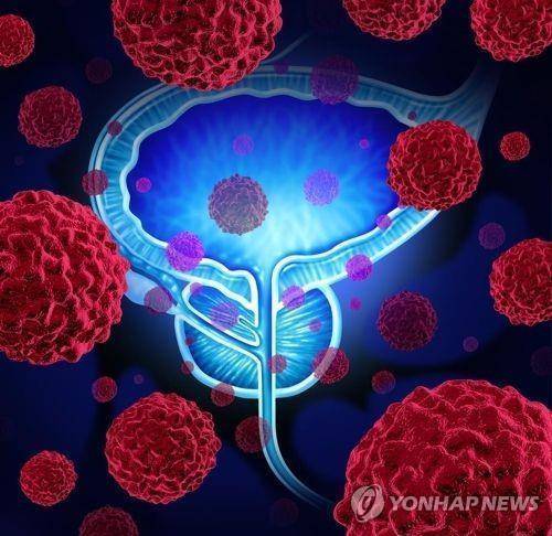 전립선암 [게티이미지뱅크 제공]