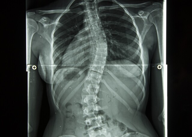 척추측만증은 정면에서 봤을 때 척추가 10도 이상 휘어 변형되는 질환을 뜻한다. 사진은 32도 가량 척추가 휜 환자의 모습. 게티이미지뱅크