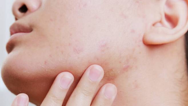 피부 트러블이 잦다면 음식을 가려 먹으면 도움이 될 수 있다. 사과, 콩, 당근, 오트밀 등 섬유질이 풍부한 식품과 연어 굴 견과류 등이 여드름 치료에 좋다. [사진= 게티이미지뱅크]