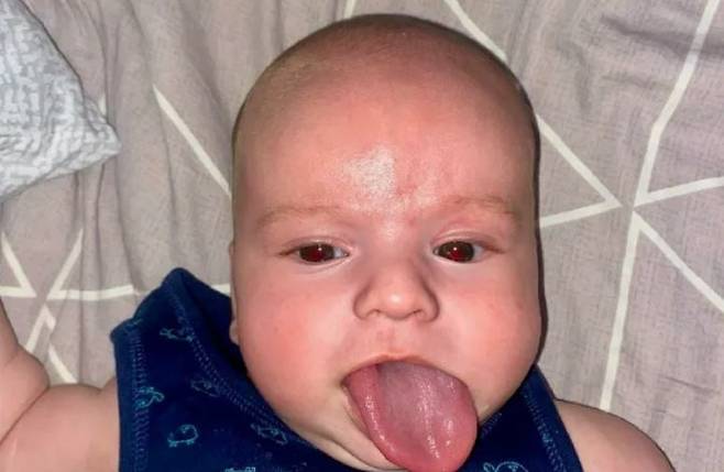 우크라이나에서 태어난 레프치코프(2)는 베크위트-위드만 증후군을 앓아 다른 아이 보다 혀가 6배 정도 큰 상태로 태어났다./사진=더 선