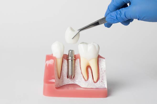 치주 질환, 충치나 외상 등 여러 이유로 치아를 상실한 경우 진행되는 임플란트 치료는 특수 금속의 나사 모양 인공구조물을 턱뼈 속에 심어 기둥을 만들고 인공치아를 새롭게 만들어 주는 방법이다. 사진은 기사와 직접적인 관련 없음. /사진=이미지투데이