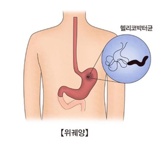 헬리코박터 파일로리 [출처: 서울아산병원]