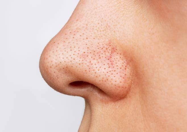 블랙헤드는 손으로 짜거나 코팩을 사용하는 것 보다 클렌징 오일을 활용해 제거하는 게 효과적이다./사진=게티이미지뱅크