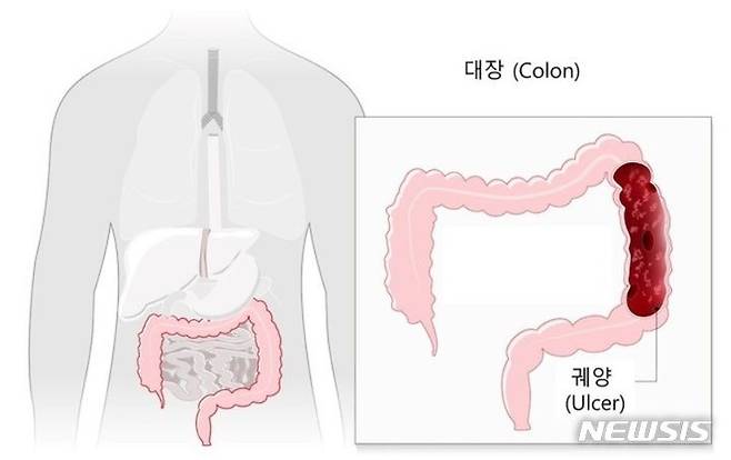 [서울=뉴시스]대장암