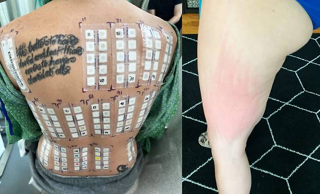 수많은 알레르기 중 정액 알레르기로 인해 고통스러운 성생활을 하고 있다는 여성의 사연이 전해졌다. 왼쪽은 테니슨이 받은 각종 알레르기 테스트 모습. 오른쪽은 정액이 닿았을 때 나타나는 피부 발진 현상. [사진=미국 일간 뉴욕포스트 캡처]