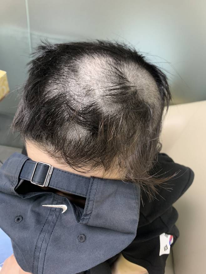 '바리캉 사건' 피해자 박수정(가명·20대)씨가 피고인 김아무개(26·구속 기소)씨로부터 바리캉으로 머리카락을 잘린 모습 ⓒ피해자 가족 제공