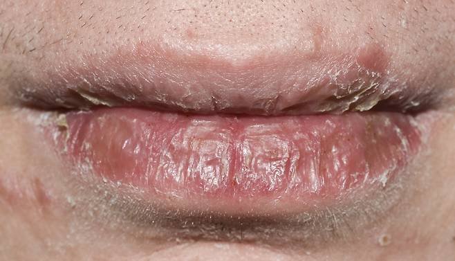 입술 각질로 고민하는 사람이 많다./사진=클립아트코리아