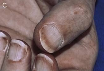 Terry's nail​/사진=The American Journal of Medicine