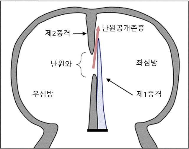 난원공개존증 모식도. 고려대 안암병원 제공