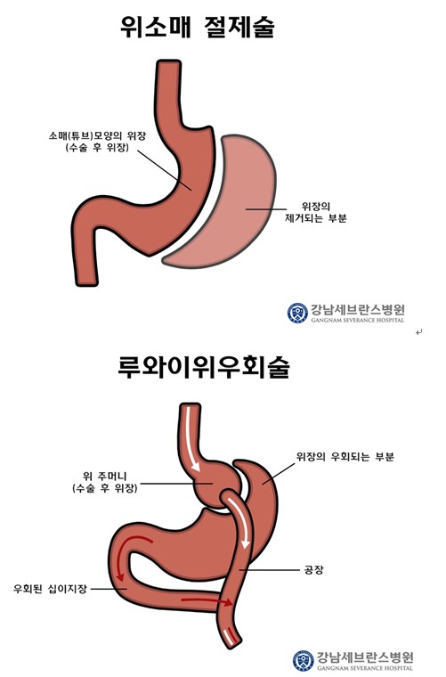 비만대사수술 방법/강남세브란스병원 제공