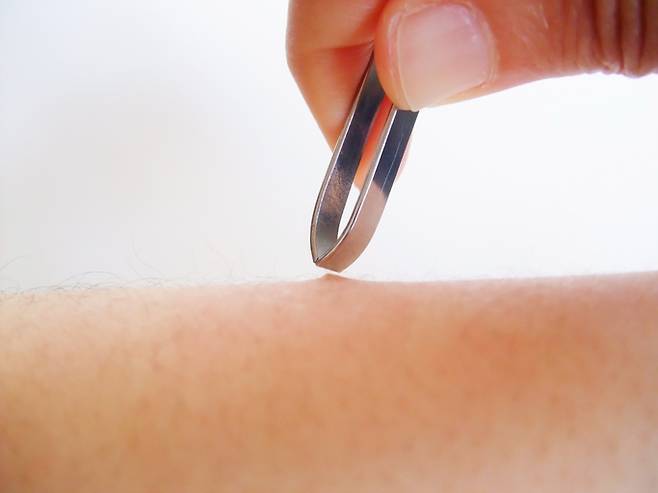 족집게를 잘못 하용하면, 발적, 인그로운 헤어, 노란 고름, 심지어 감염까지 생겨 주의가 필요하다. [사진= 게티이미지뱅크]