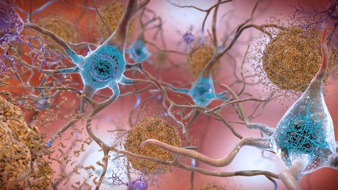 알츠하이머 치매 환자의 뇌에는 아밀로이드 베타 단백질(갈색)이 신경세포에 덩어리를 이루고 있고, 타우 단백질(파란색)도 비정상적으로 뭉쳐있다./미 국립보건원(NIH)