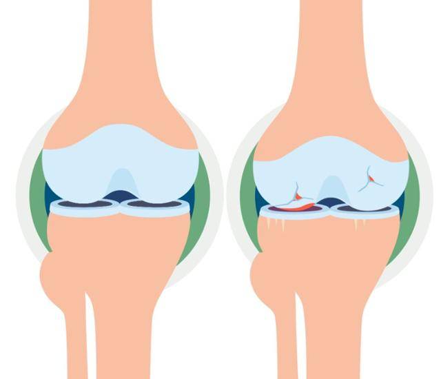 관절의 형태, 정상 관절(왼), 관절염이 생긴 관절. 게티이미지뱅크