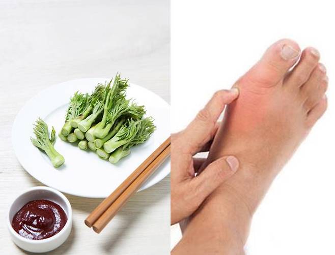 통풍 환자는 요산 배출이 원활하지 않으므로 요산의 전구물질인 퓨린 함량이 높은 식품은 섭취를 자제해야 한다. [사진= 게티이미지뱅크]