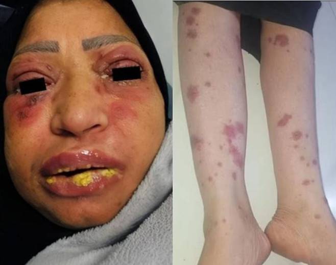 이부프로펜 복용 후 '스티븐 존슨 증후군'을 겪은 여성의 모습. [사진=임상사례보고 저널]