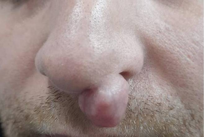 35세 남성의 코에 가로 2cm, 세로 1.5cm 크기의 연골모양땀관종이 자라난 모습./사진=국제외과학회지 사례보고서