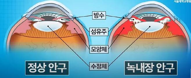 정상 안구와 녹내장 안구 비교