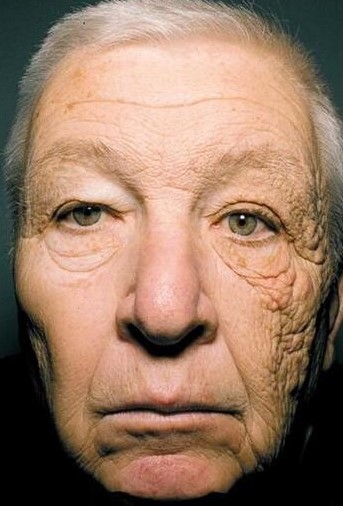 미국서 28년간 트럭 운전한 69세 남성의 얼굴 사진. 남성의 오른쪽 뺨에 비해 왼쪽 뺨은 피부 손상이 심각한 상태다. 하루 종일 운전을 하면서 수십 년간 왼쪽 뺨에 직접적으로 자외선 노출, 왼쪽 뺨만 유독 피부 주름이 자글자글하다./뉴잉글랜드저널오브메디신