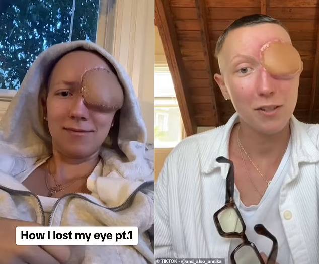 부비동염인줄 알았으나 암에 걸린 여성 사연이 공개됐다. CT 검사 결과 오른쪽 눈가에는 골프공 크기의 종양이 있었고 제거술 이후 해당 부위를 허벅지 피부로 조직을 메우고 있다. 허벅지가 햇빛에 그을렸기 때문에 피부색이 조금 다른 모습이다.  [사진=영국 일간 데일리메일 보도 캡처/틱톡 'and_also_annika']