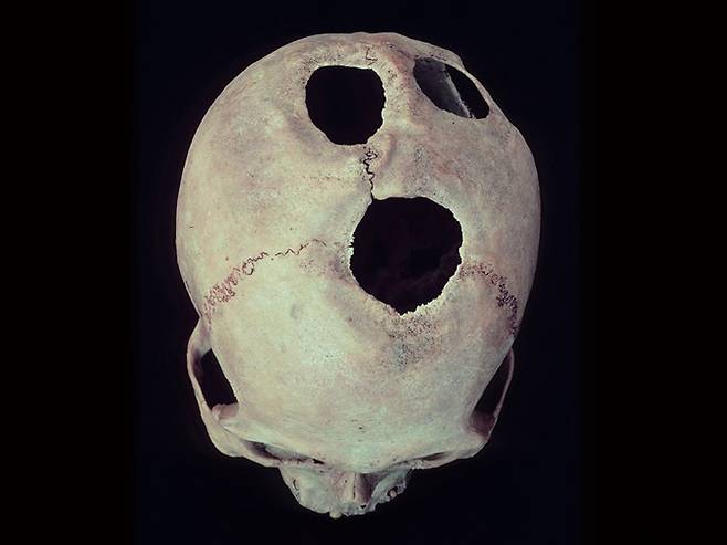 중국에서 기원전 1600년 전부터 두개골 절제술을 했다는 연구 결과가 나왔다. John W. Verano 제공