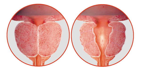 전립선이 커져 요로를 막은 사진(왼쪽)과 커진 전립선을 특수 실로 묶어 요로를 넓힌 사진(오른쪽).