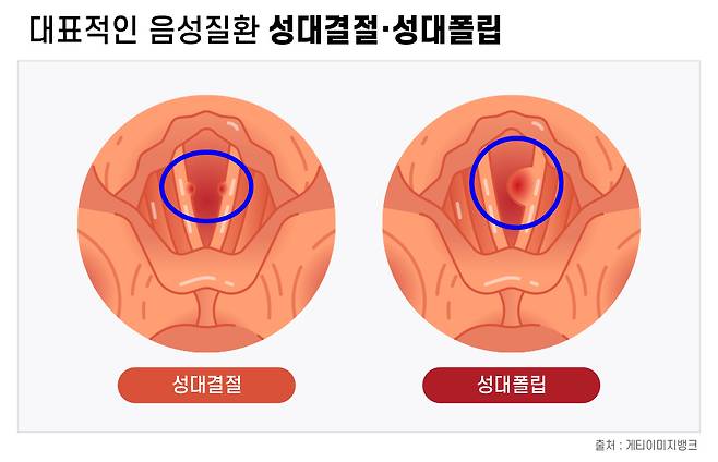 성대결절과 성대폴립./사진=강동경희대병원 제공