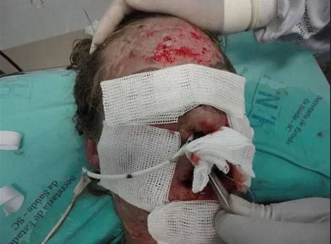 생리통 완화를 위해 이부프로펜을 복용했다가 얼굴에 끔찍한 부작용을 겪은 브라질 30대 여성의 사연이 공개됐다./사진=더 선