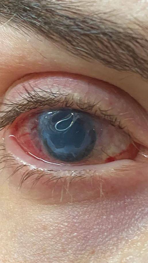 각막에 손상을 입은 재클린의 눈. 그는 각막 이식 등 24차례의 수술을 받아야 했다./사진=더 선