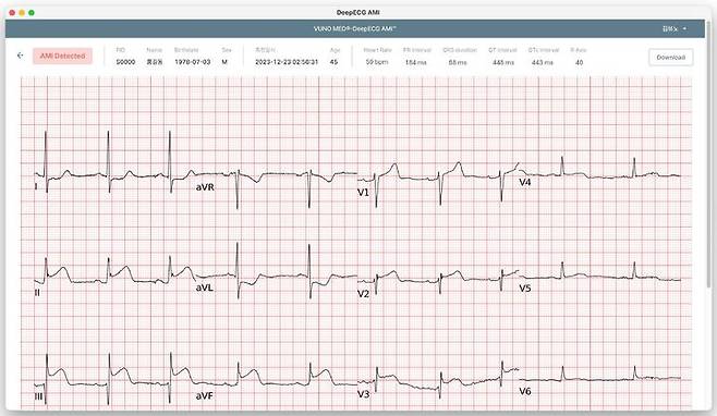 [서울=뉴시스] 9일 의료 인공지능(AI) 기업 뷰노는 식품의약품안전처로부터 AI 기반 급성심근경색 탐지 소프트웨어 뷰노메드 딥 ECG AMI의 의료기기 허가를 획득했다고 밝혔다. (사진=뷰노 제공) 2024.05.09. photo@newsis.com *재판매 및 DB 금지