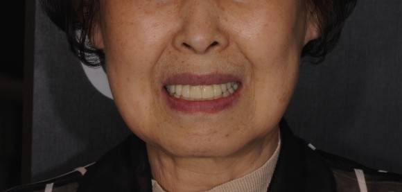 풀아치(Full-Arch) 임플란트가 틀니의 대안으로 고려되고 있다.