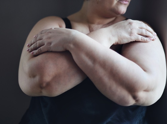 팔에 살이 많이 찐 사람은 척추 및 척추 뼈 골절 위험이 상대적으로 더 높다. 팔의 총 지방량이 많은 50대 이상은 척추 및 척추 뼈 골절에 각별히 조싱해야 한다.[사진= 게티이미지뱅크]