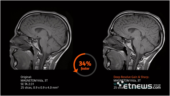 지멘스 헬시니어스의 딥 리졸브 기술이 적용된 MRI 마그네톰 비다 사진 촬영 예시. 딥 리졸브 기술 적용 후 더욱 선명해진 영상 이미지 모습.