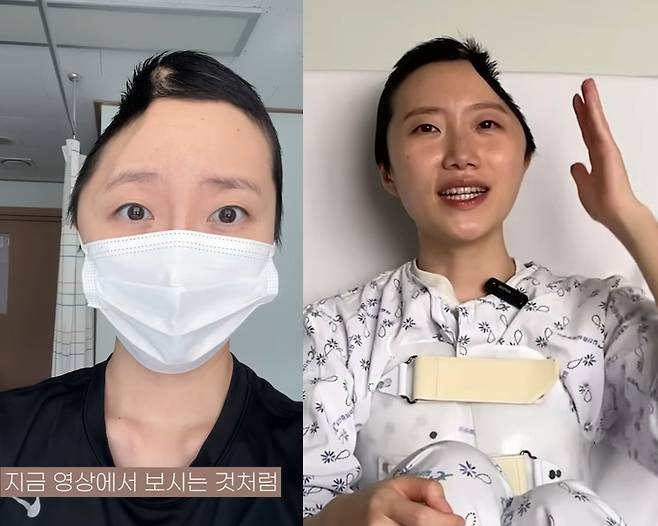 불의의 사고로 왼쪽 머리뼈 일부를 절개하는 수술을 한 우은빈 씨. 왼쪽 사진은 우 씨가 촬영한 좌우반전 된 셀카. [유튜브 채널 '우자까' 캡쳐]