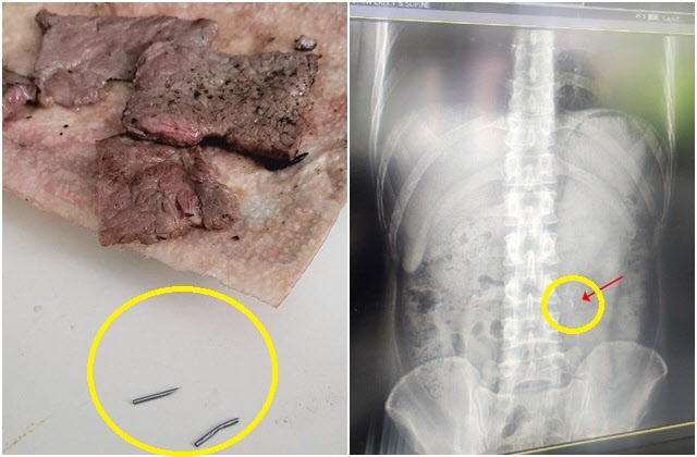 제보자가 공개한 한우에서 발견된 바늘, 남편의 엑스레이. 바늘 추정 조각이 발견됐다. (사진=사회관계망서비스)