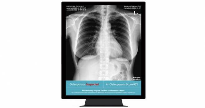 프로메디우스의 주요 제품 'PROS CXR: OSTEO'는 흉부 X-ray를 활용해 즉각적으로 검사를 돕는 딥 러닝 스크리닝 솔루션이다. /사진=프로메디우스 홈페이지 캡쳐