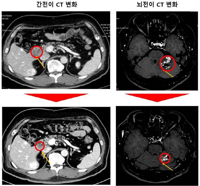 간과 뇌에 암이 전이된 환자의 간과 뇌종양 크기가 각각 감소한 모습, 암 병변은 87% 정도 감소했고 18개월 이상 반응을 유지 중이다.