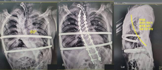 해당 환자의 수술 전 척추 모습(왼쪽부터 1, 2번째)과 수술 후 교정된 모습. [사진=서울특별시 서남병원]