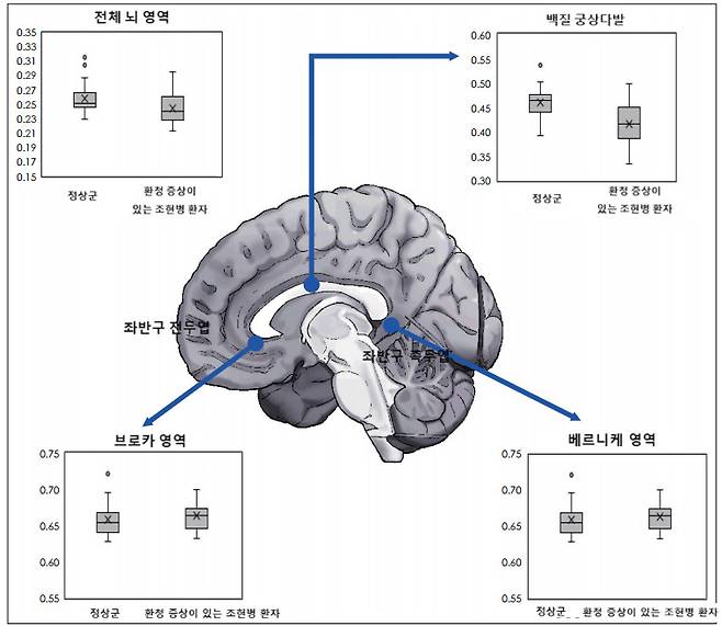 최근 국립법무병원 연구팀이 조현병 증상 발병과 관련이 있다고 규명한 뇌영역 위치와 정상군 및 환청 증상을 동반한 조현병 환자의 FA 수치 비교. 이들 환자군은 정상군과 비교해 백질궁상다발의 FA 수치가 낮았지만, 브로카와 베르니케영역의 FA 값에선 유의미한 차이가 없었다. 정상군은 33명, 환자군은 35명이었다. 참가자들은 국립법무병원 기관생명윤리위원회의 관리, 감독, 승인 아래 연구윤리를 준수하고 본인 동의에 따라 연구에 참여했다. [자료=«신경정신의학»]