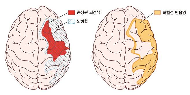 허혈성 반음영은 다시 혈류가 공급되면 살릴 수 있는 부위다./사진=강동경희대병원 제공