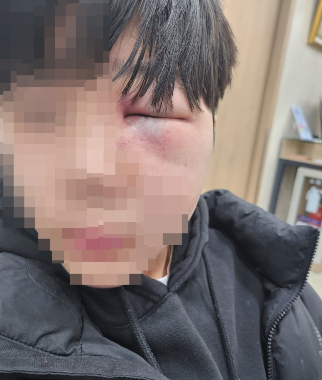 폭행으로 망막이 훼손된 학생 얼굴. [연합뉴스]
