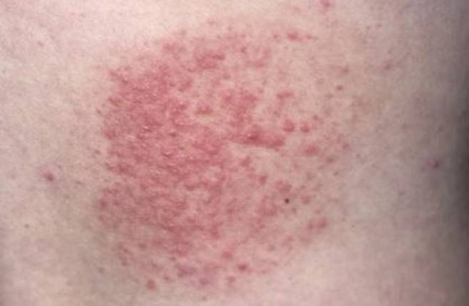 태양광선에 노출된 후, 피부에 가려움이나 발진 증상이 나타난다면 햇빛 알레르기를 의심해야 한다./사진=더 선