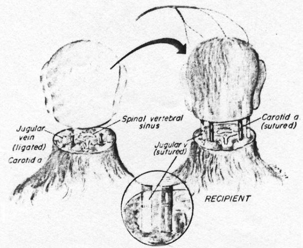 1970년 두 마리 원숭이의 머리를 맞교환하는데 성공한 로버트 화이트 교수가 그린 머리이식술 개념도. /학술지 국제외과신경학 제공