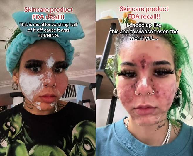 유통기한 지난 크림을 사용했다가 세균에 감염된 여성. [사진=틱톡 계정 'BeastEater' 영상 캡처]