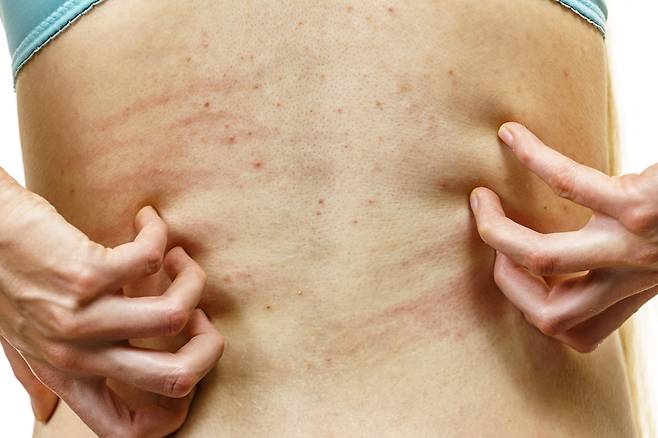 땀띠는 가려워도 긁지 말고, 시원한 환경을 만들어주는 게 좋다./사진=게티이미지뱅크