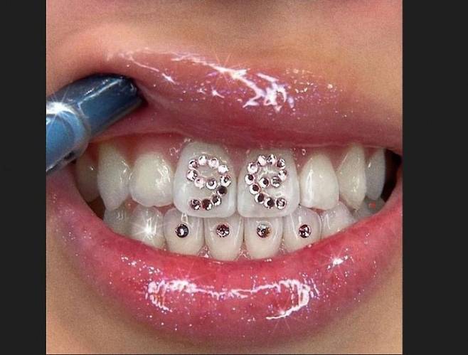 투스젬 시술을 한 치아의 모습. /사진=인스타그램갈무리