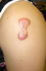 켈로이드성 피부를 가졌는지 스스로 확인하고 싶다면 불주사로 알려진 BCG 접종을 맞은 자리를 확인하면 된다.​./사진=Dermatology and Therapy