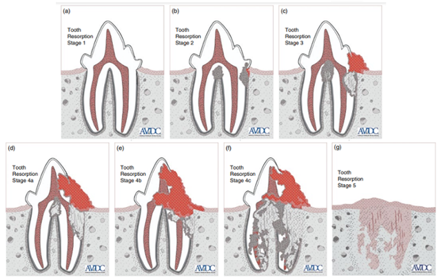 미국 수의치과학회(American Veterinary Dental College)가 제시한 고양이 치아흡수성 병변의 다섯 단계. AVDC