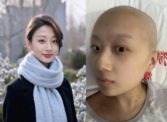 암투병 중인 궈장씨의 AI사진(왼쪽)과 현재 모습. 웨이보